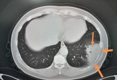 ​疑似病人的临床表现(新型冠状病毒肺炎疑似病例有哪些症状)