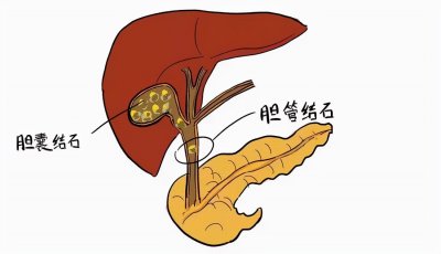 ​胆结石有什么症状有哪些（胆结石的症状有哪些？中医怎么治疗胆结石，饮食注意