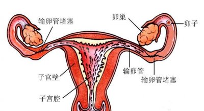 ​输卵管造影视频 您了解输卵管造影检查吗？