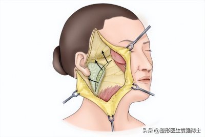 ​面部松弛法令纹严重怎么改善，只需要做到这几件事