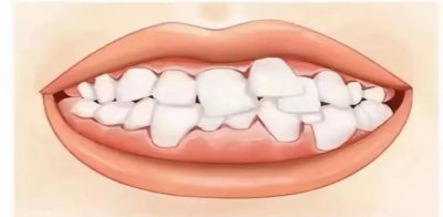 ​如何解决塞牙缝的问题   解决方法送给你